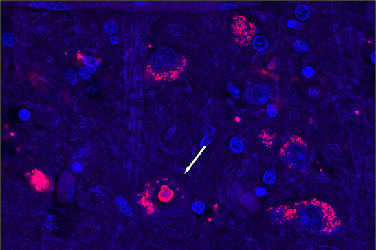 In rosso gli aggregati proteici dannosi che si formano nel cervello delle persone affette (fonte: Mandi Gandelman, Ph.D.)